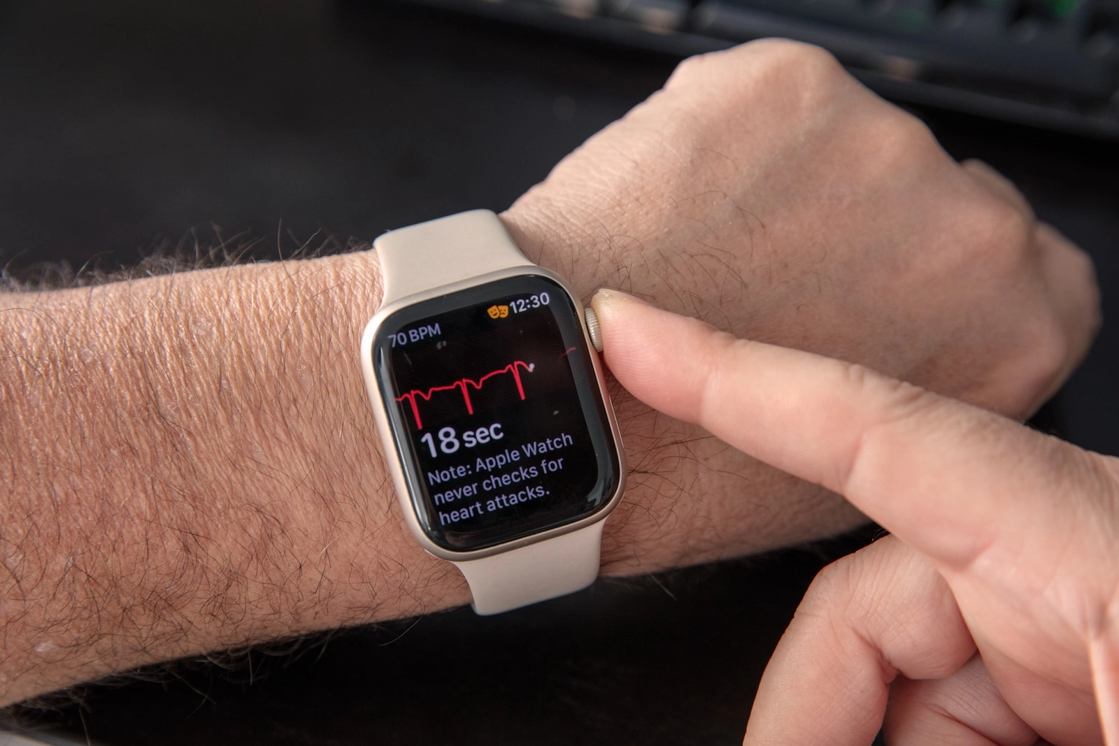 Apple Watch Vorhofflimmern